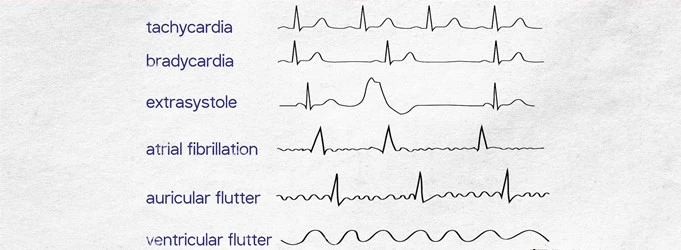 arrhythmia