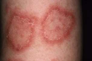 Discoid Lupus Erythematosus DLE