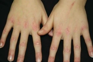 Dermatomyositis