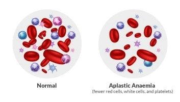 Aplastic Anemia