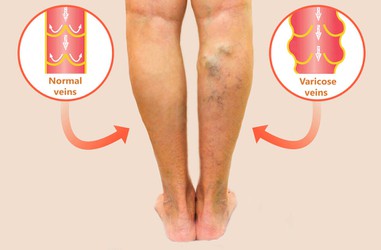 Varicose Veins Varicose Veins