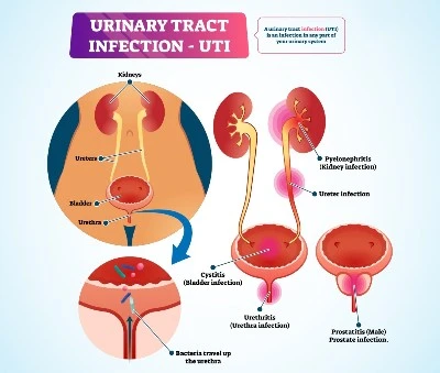 Urinary Tract Infections Urinary Tract Infections